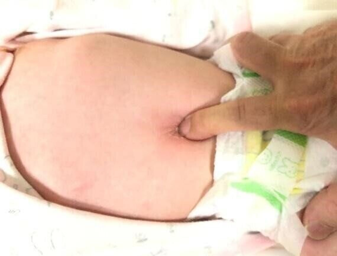 赤ちゃんの でべそ の治療は穴に合わせたオーダーメード 小児科医 たまひよ 赤ちゃんの でべそ の治療は穴に合わせたオーダーメード 小児科医 たまひよ