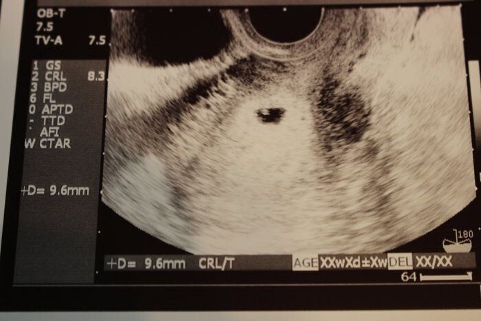 妊娠5週目のエコー写真