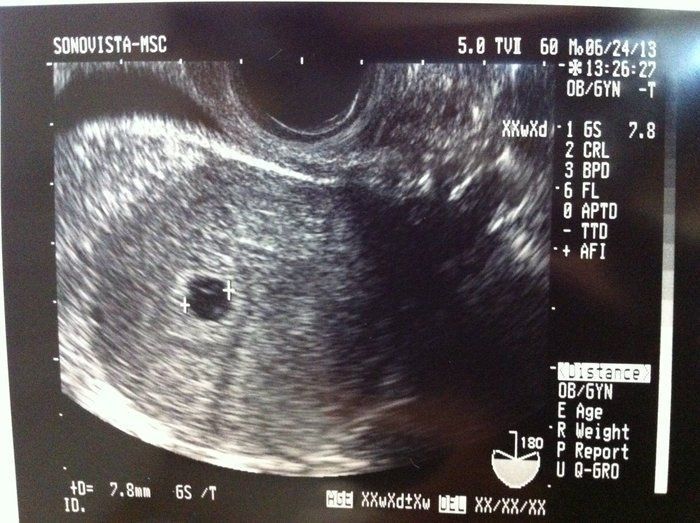 妊娠6ヶ月（妊娠20週,21週,22週,23週,妊娠中期）の超音波写真