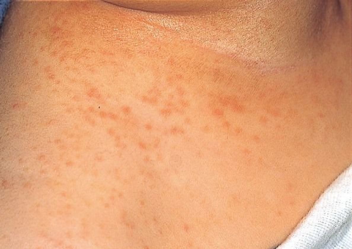 赤ちゃんの皮膚の病気 あせもの症状とケア 医師監修 たまひよ 赤ちゃんの皮膚の病気 あせもの症状とケア 医師監修 たまひよ