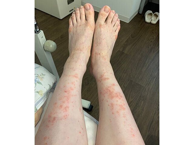 momoさん 3つ子育児体験談　妊娠性湿疹