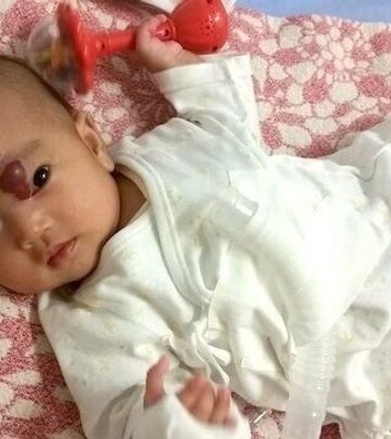 生後1カ月の娘 目の上のあざが 日ごとに大きく 自分を責め続けた日々 体験記 たまひよ