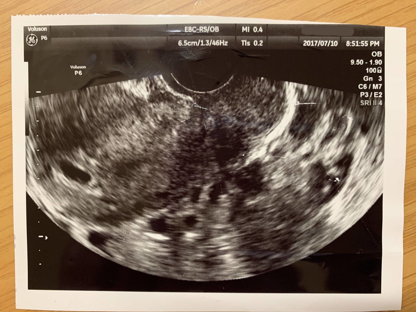 妊娠28週でマイコプラズマ肺炎に 第3子エコー体験記 たまひよ 妊娠28週でマイコプラズマ肺炎に 第3子エコー体験記 たまひよ