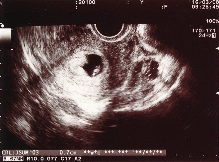 妊娠6週目のエコー写真