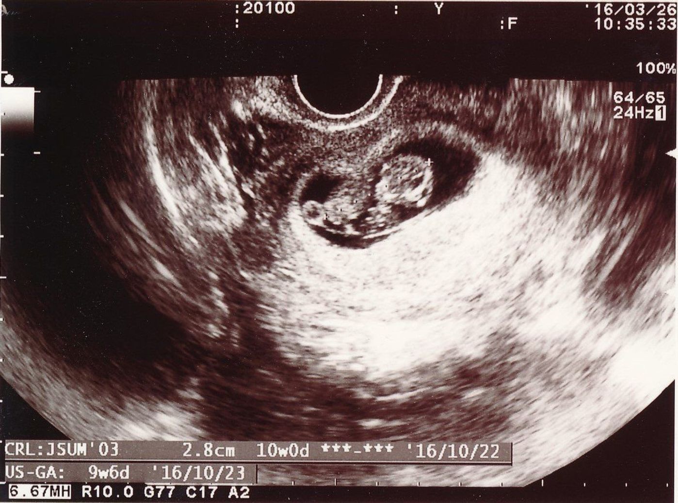 思いがけず授かった2人目は43歳の高齢出産 健診は不安と期待との板挟み たまひよ 思いがけず授かった2人目は43歳の高齢出産 健診は不安と期待との板挟み たまひよ