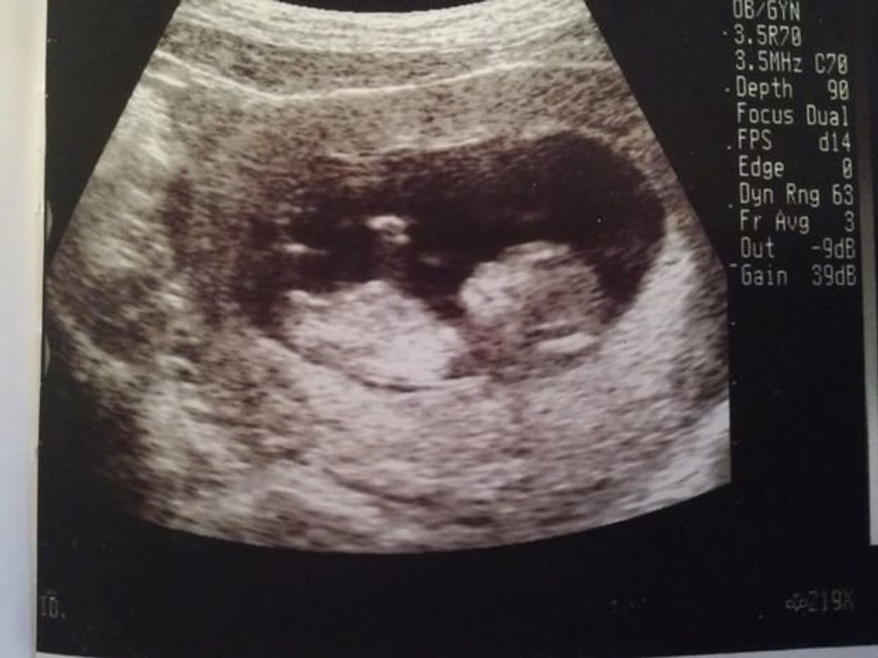 2度 逆子 になった胎児はもう小学生 子どもと共に読み返した当時の日記 エコー画像 たまひよ 2度 逆子 になった胎児はもう小学生 子どもと共に読み返した当時の日記 エコー画像 たまひよ