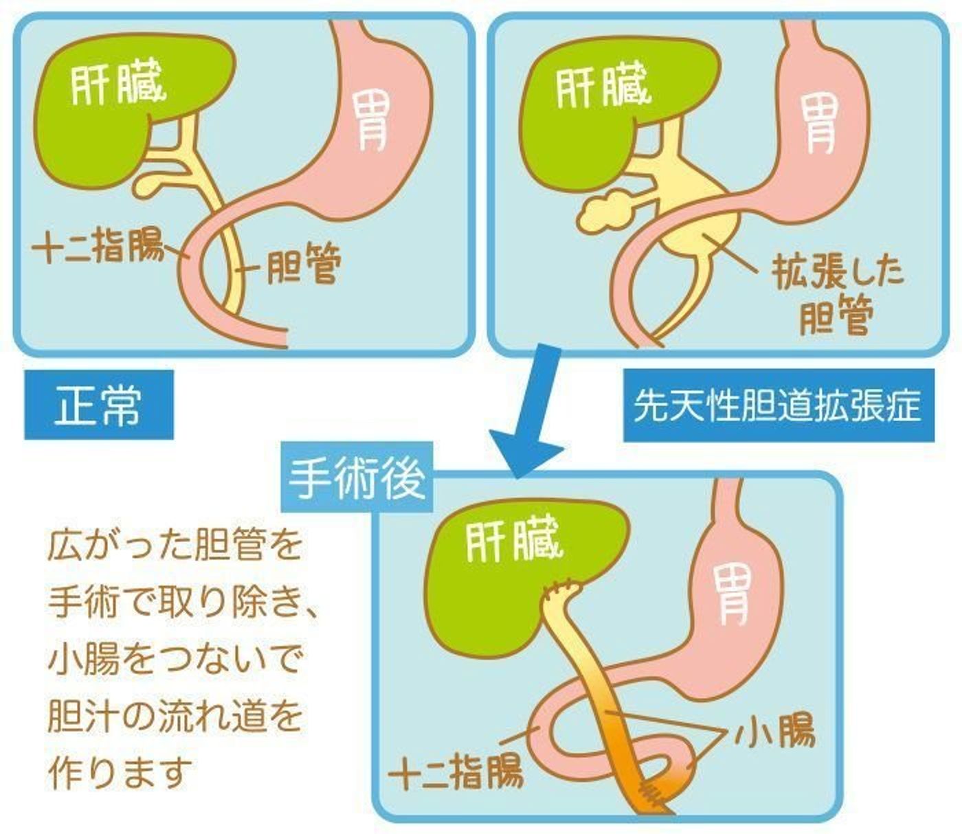 赤ちゃんのおなかの病気 先天性胆道拡張症の症状とケア 医師監修 たまひよ 赤ちゃんのおなかの病気 先天性胆道拡張症の症状とケア 医師監修 たまひよ