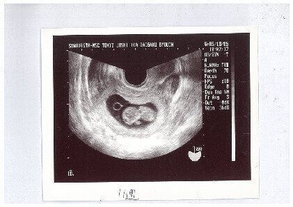 妊娠初期の超音波検査でわかること 医師が確認していることは 産婦人科医 たまひよ