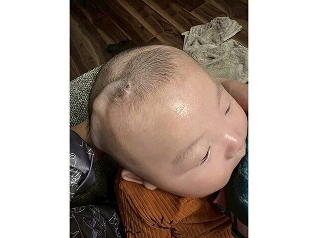 シャント手術後のそうきくん