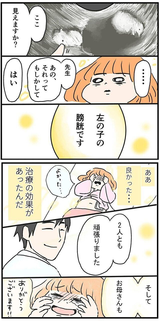 双子妊娠・出産体験談　さゆりさん“双胎間輸血症候群”になった話