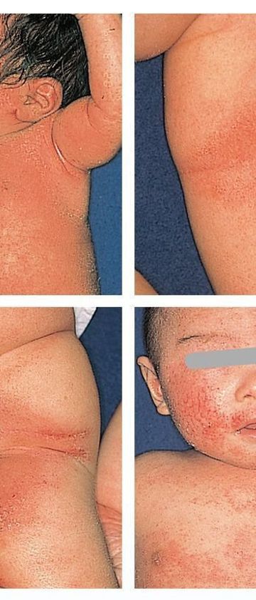 赤ちゃんの皮膚の病気 アトピー性皮膚炎の症状とケア 医師監修 たまひよ 赤ちゃんの皮膚の病気 アトピー性皮膚炎の症状とケア 医師監修 たまひよ