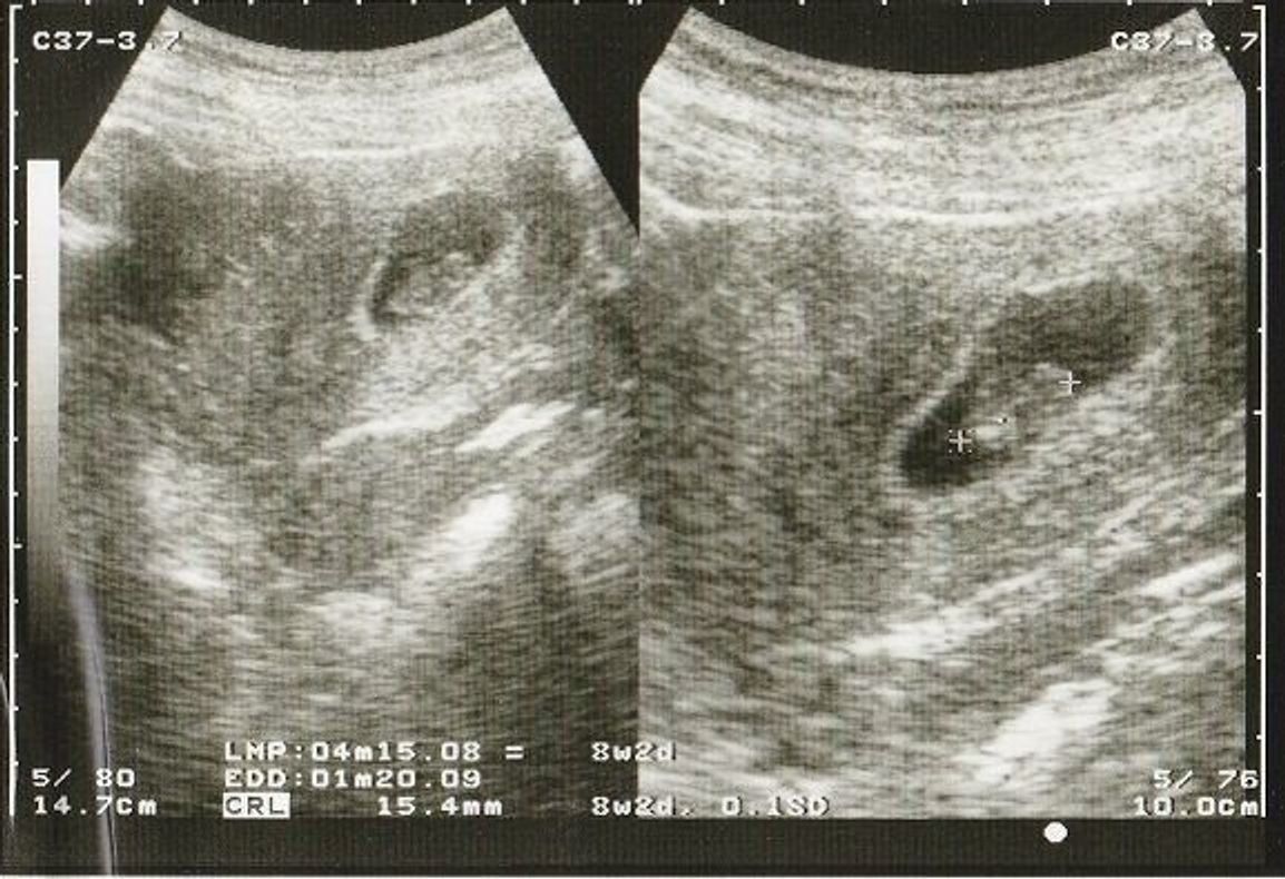 妊娠8週 赤ちゃんのエコー写真 超音波写真まとめ たまひよ 妊娠8週 赤ちゃんのエコー写真 超音波写真まとめ たまひよ