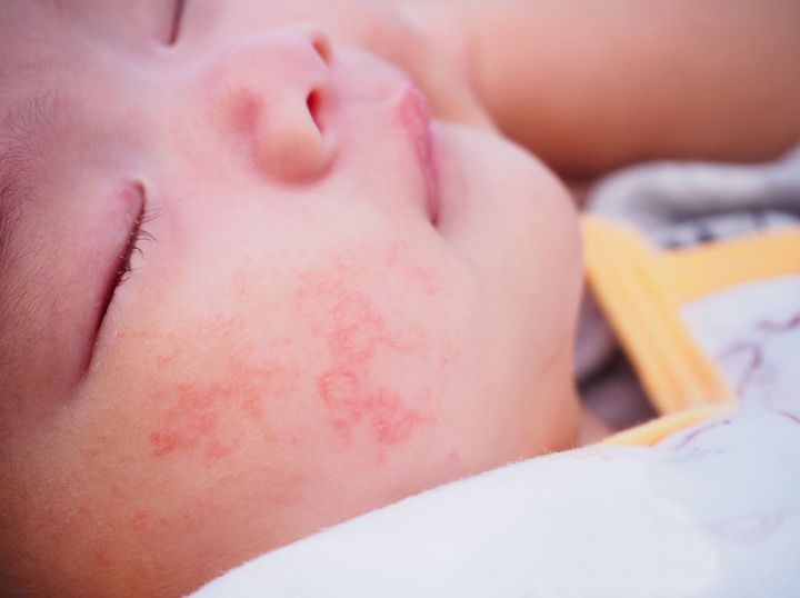 あぶら取りフィルムで低月齢赤ちゃんのアトピー性皮膚炎がわかる 広く普及すれば 食物アレルギーが減少する可能性も 専門医 たまひよ あぶら取りフィルムで低月齢赤ちゃんのアトピー性皮膚炎がわかる 広く普及すれば 食物アレルギーが減少する可能性も 専門医 たまひよ