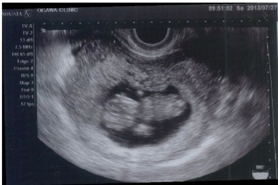 超音波検査 2d 3d 4dはどう違う 写真で赤ちゃんの顔や手足を見分けるコツは たまひよ 超音波検査 2d 3d 4dはどう違う 写真で赤ちゃんの顔や手足を見分けるコツは たまひよ