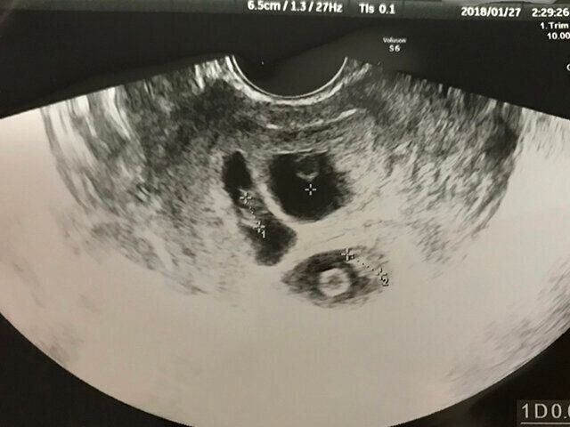 3つ子妊娠・出産体験談 ３つ子のエコー写真　二姫三太郎ママインタビュー