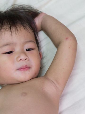 赤ちゃんの感染症 はしか 麻疹の症状とケア 医師監修 たまひよ 赤ちゃんの感染症 はしか 麻疹の症状とケア 医師監修 たまひよ