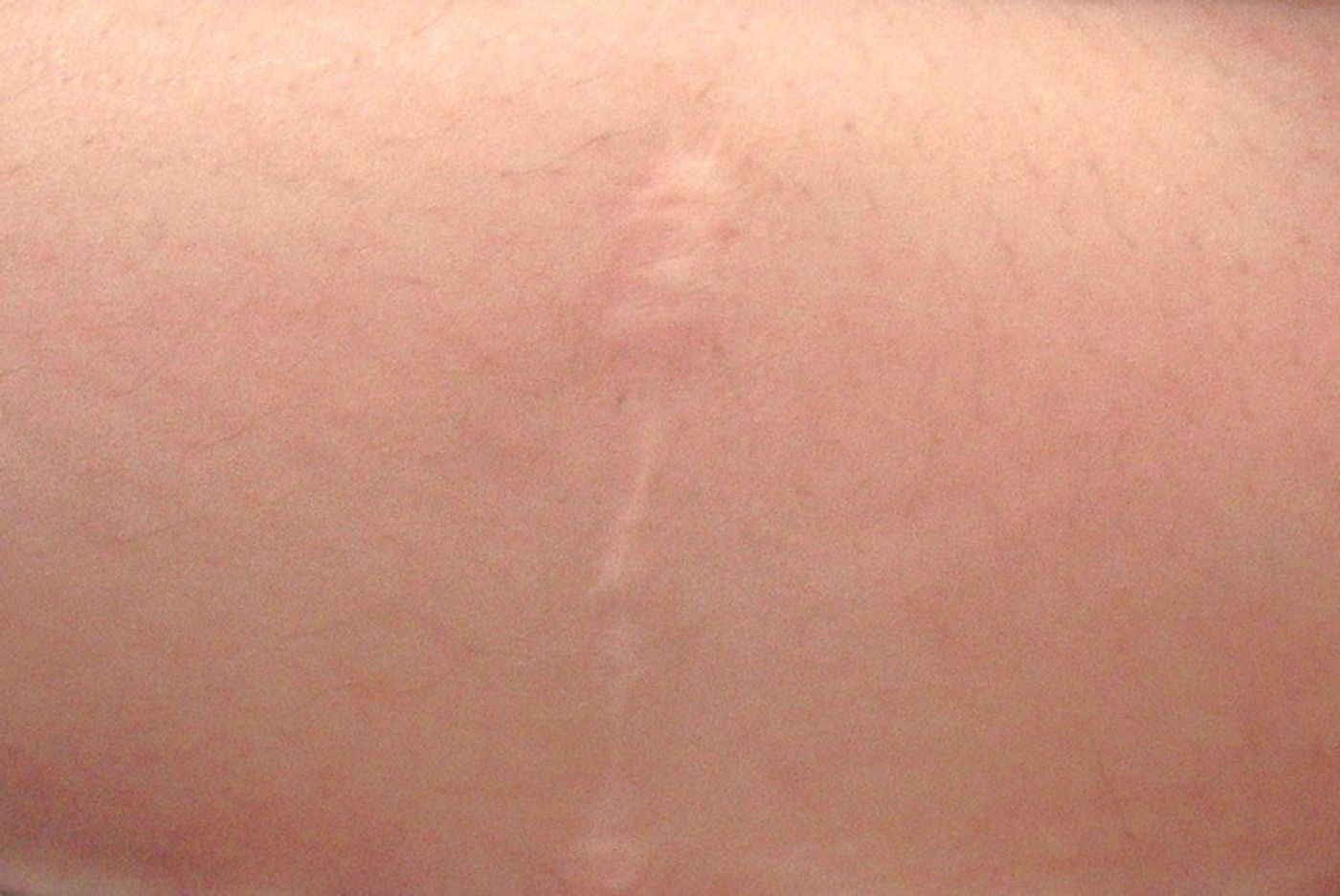 医師監修 帝王切開の傷をきれいに治す術後ケアのコツ たまひよ 医師監修 帝王切開の傷をきれいに治す術後ケアのコツ たまひよ