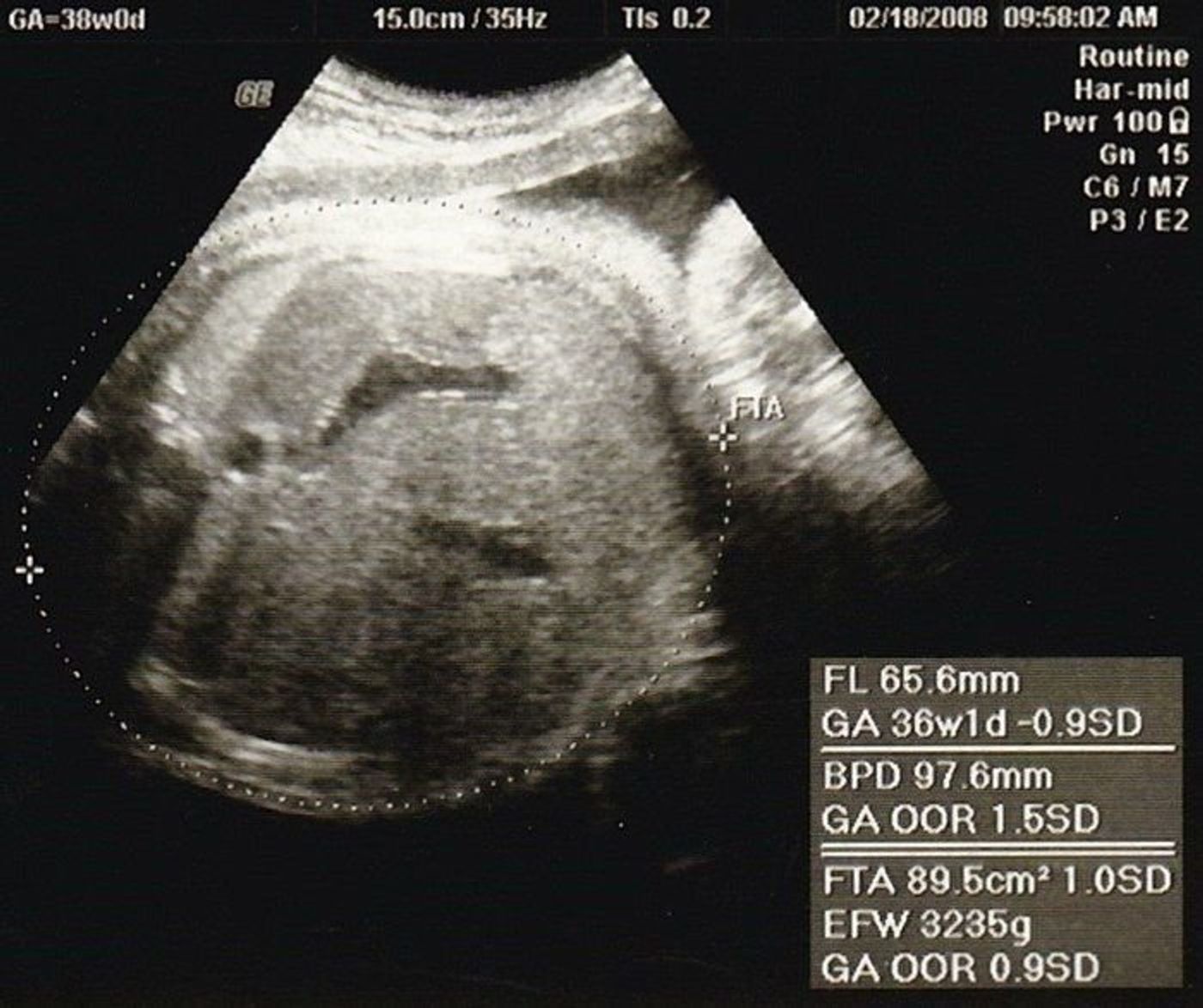 妊娠38週 赤ちゃんのエコー写真 超音波写真まとめ たまひよ 妊娠38週 赤ちゃんのエコー写真 超音波写真まとめ たまひよ