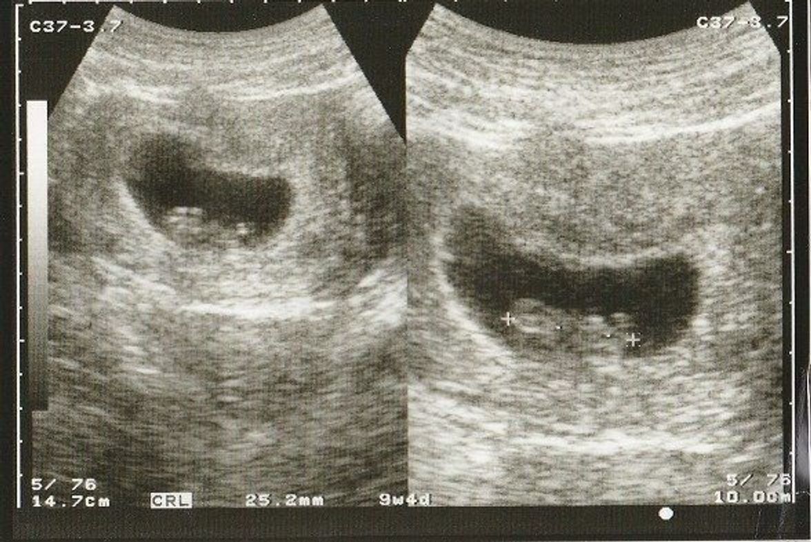 妊娠9週 赤ちゃんのエコー写真 超音波写真まとめ たまひよ 妊娠9週 赤ちゃんのエコー写真 超音波写真まとめ たまひよ