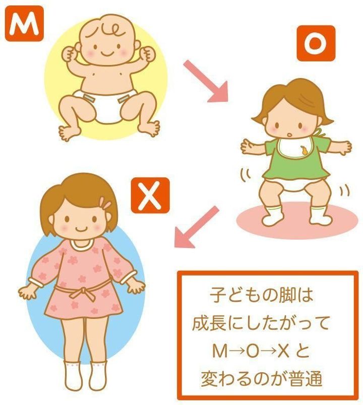 医師監修 赤ちゃんの骨 関節の病気 O脚 X脚の症状とケア たまひよ 医師監修 赤ちゃんの骨 関節の病気 O脚 X脚の症状とケア たまひよ