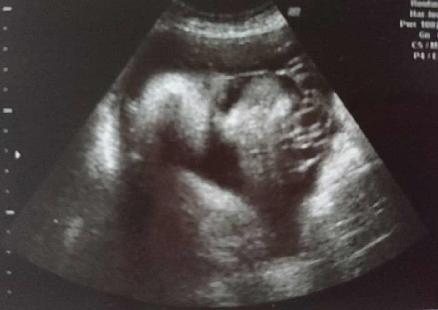 妊娠33週 赤ちゃんのエコー写真 超音波写真まとめ たまひよ 妊娠33週 赤ちゃんのエコー写真 超音波写真まとめ たまひよ
