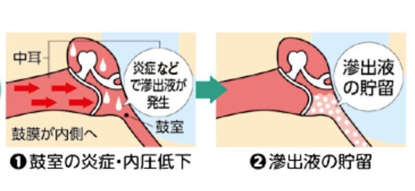 無症状で気づかれにくく 難聴の原因になることも 滲出性中耳炎 ってどんな病気 専門医 たまひよ 無症状で気づかれにくく 難聴の原因になることも 滲出性中耳炎 ってどんな病気 専門医 たまひよ