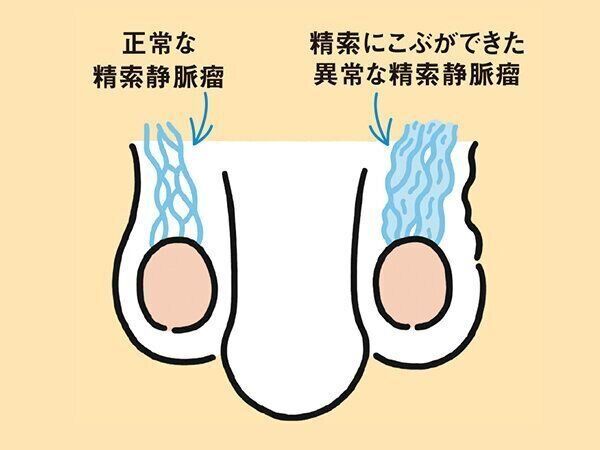 精索静脈瘤の症状・原因