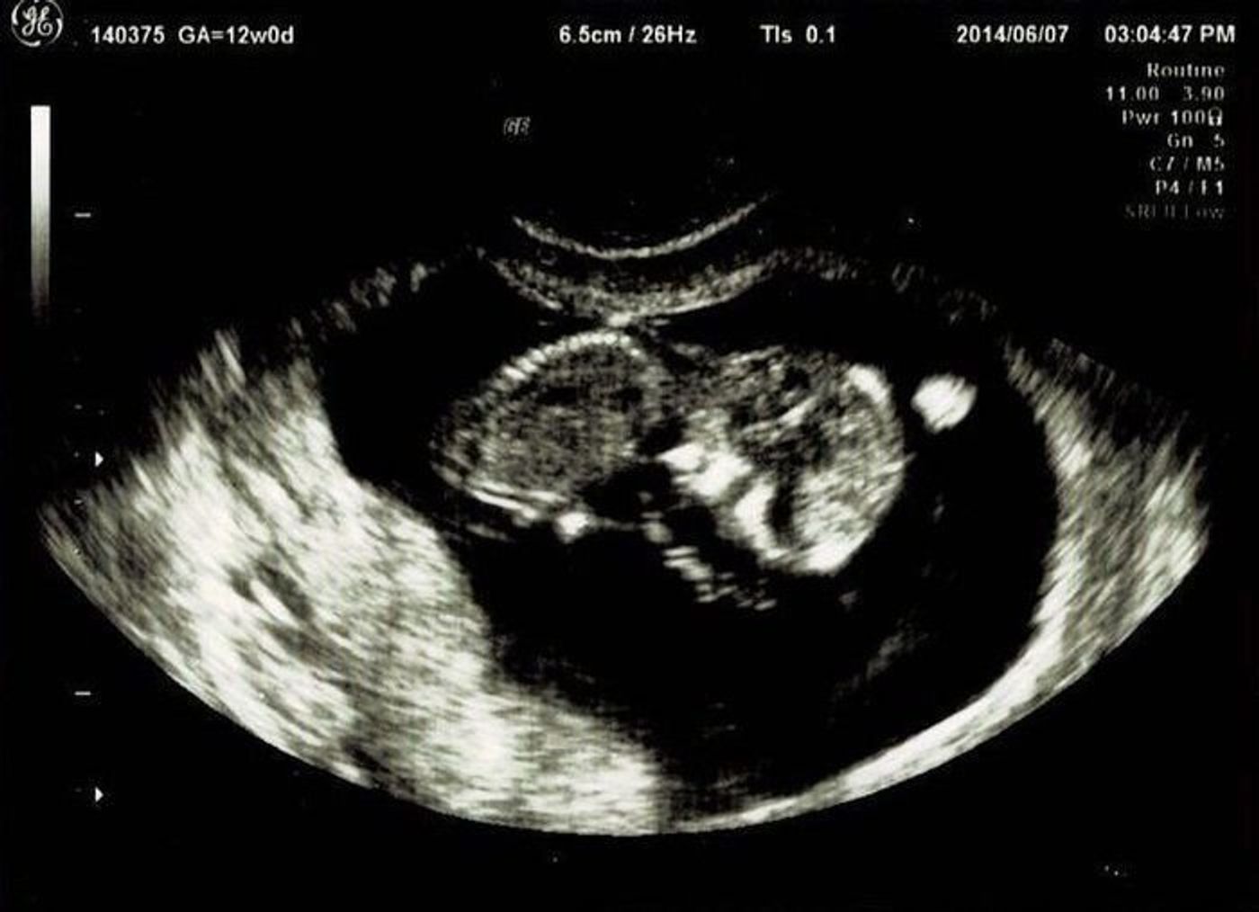 妊娠12週 赤ちゃんのエコー写真 超音波写真まとめ たまひよ 妊娠12週 赤ちゃんのエコー写真 超音波写真まとめ たまひよ