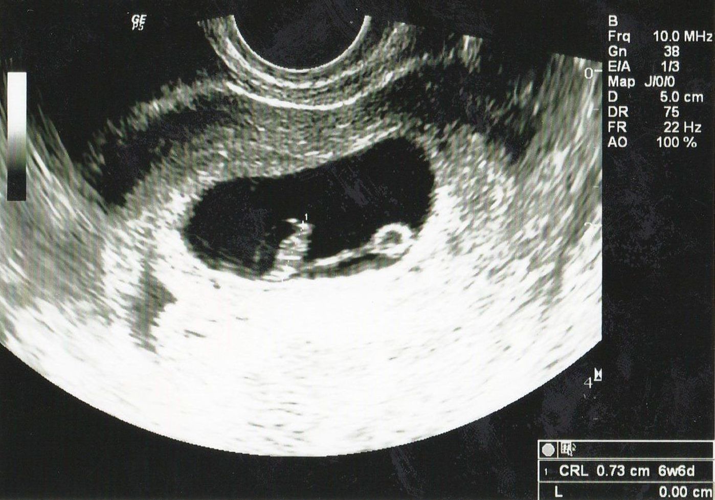 妊娠 素人投稿アルバム エコー画像で振り返る、私に宿った小さな命が大きく育って誕生するまでの記録|たまひよ