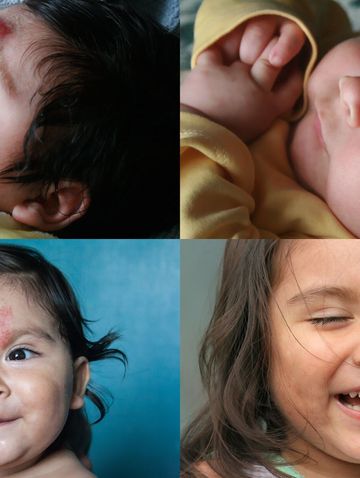 赤ちゃんのあざ 心配しなくていい 治療すべき 最新レーザー治療情報も 専門医 たまひよ