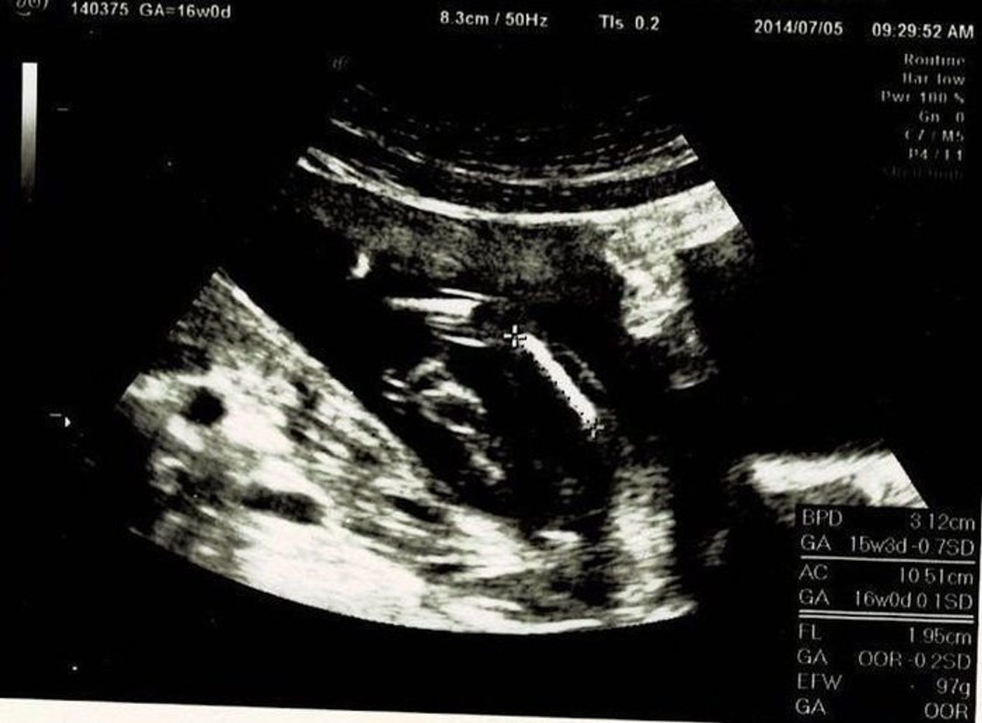 妊娠16週 赤ちゃんのエコー写真 超音波写真まとめ たまひよ 妊娠16週 赤ちゃんのエコー写真 超音波写真まとめ たまひよ