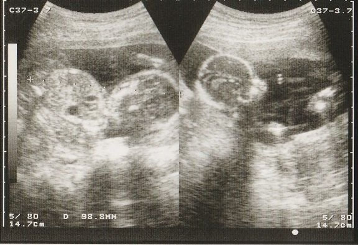 妊娠16週 赤ちゃんのエコー写真 超音波写真まとめ たまひよ 妊娠16週 赤ちゃんのエコー写真 超音波写真まとめ たまひよ