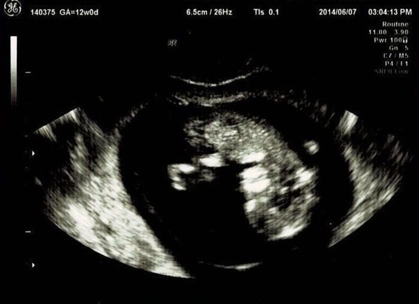 妊娠12週 赤ちゃんのエコー写真 超音波写真まとめ たまひよ 妊娠12週 赤ちゃんのエコー写真 超音波写真まとめ たまひよ