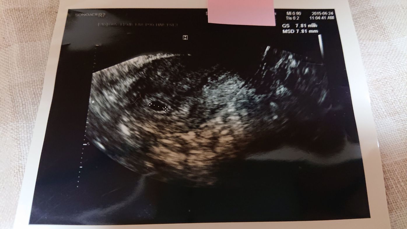 フライングでも陽性反応 そこから始まった妊娠エコー体験 たまひよ フライングでも陽性反応 そこから始まった妊娠エコー体験 たまひよ