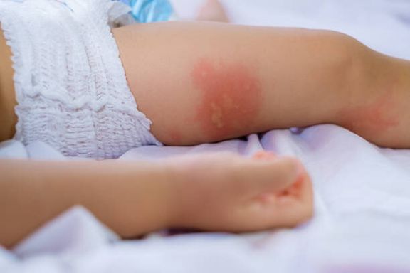 食物アレルギーに苦しんで、皮膚の発赤の小さな子