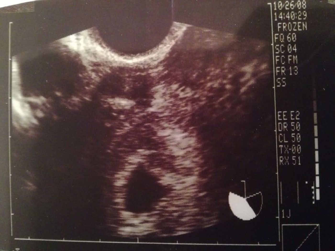 2度 逆子 になった胎児はもう小学生 子どもと共に読み返した当時の日記 エコー画像 たまひよ 2度 逆子 になった胎児はもう小学生 子どもと共に読み返した当時の日記 エコー画像 たまひよ