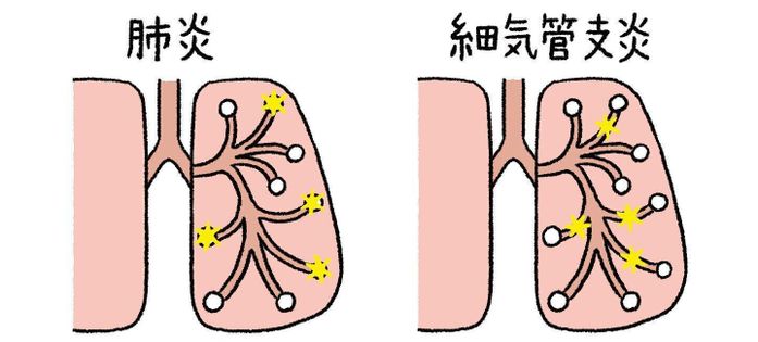 RSウイルス感染症の重症化リスク