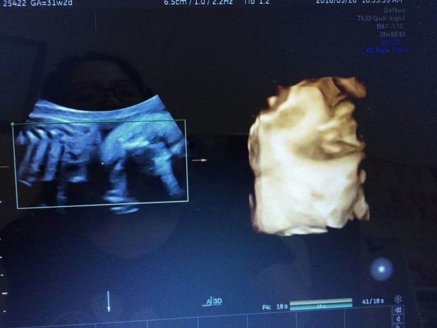 妊娠31週 赤ちゃんのエコー写真 超音波写真まとめ たまひよ 妊娠31週 赤ちゃんのエコー写真 超音波写真まとめ たまひよ