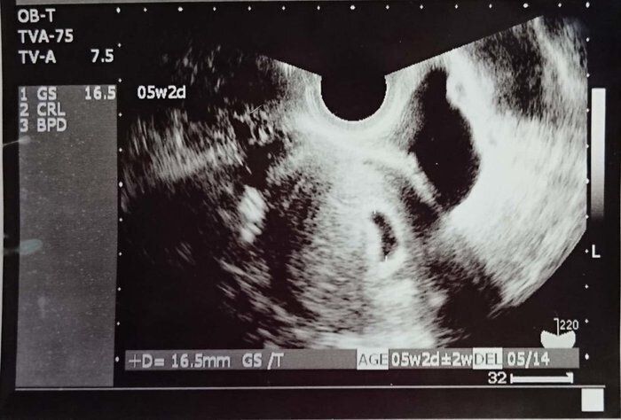 妊娠5週目のエコー写真