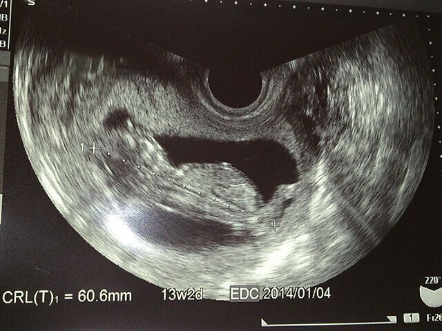 ダウン症の双子 優馬君と風馬君 「NPO法人つなぐ」桐淵良美さんインタビュー