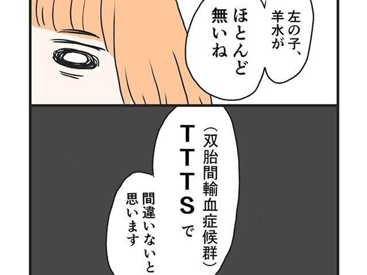 まさか自分が おなかにずっと ごめんね ごめん と泣いた日々 双胎間輸血症候群 になった話 たまひよ まさか自分が おなかにずっと ごめんね ごめん と泣いた日々 双胎間輸血症候群 になった話 たまひよ