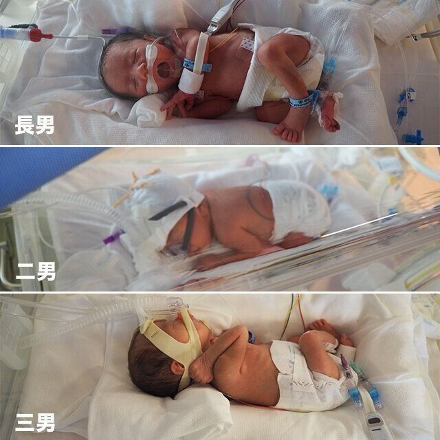 momoさん 3つ子育児体験談　入院中の３つ子