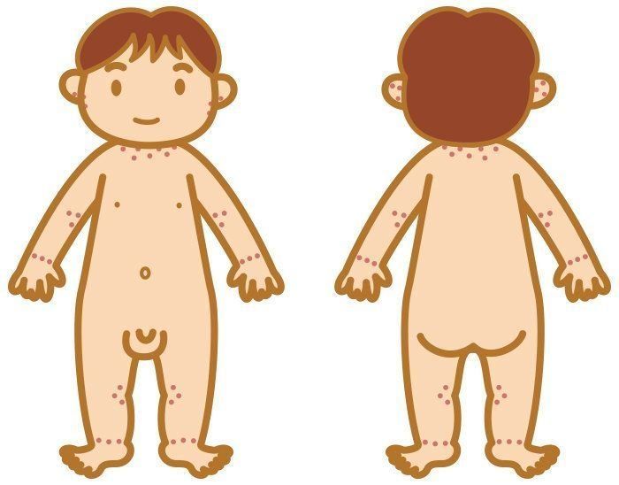 赤ちゃんの皮膚の病気 アトピー性皮膚炎の症状とケア 医師監修 たまひよ