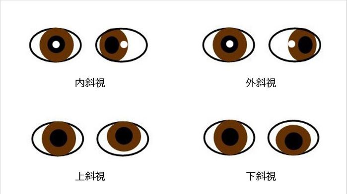 目の位置が変?これって斜視!?気づいてあげることが大切【ママ眼科医】|たまひよ
