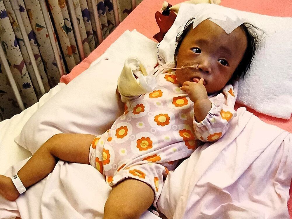 1歳6カ月ごろ水頭症術後のひーちゃん