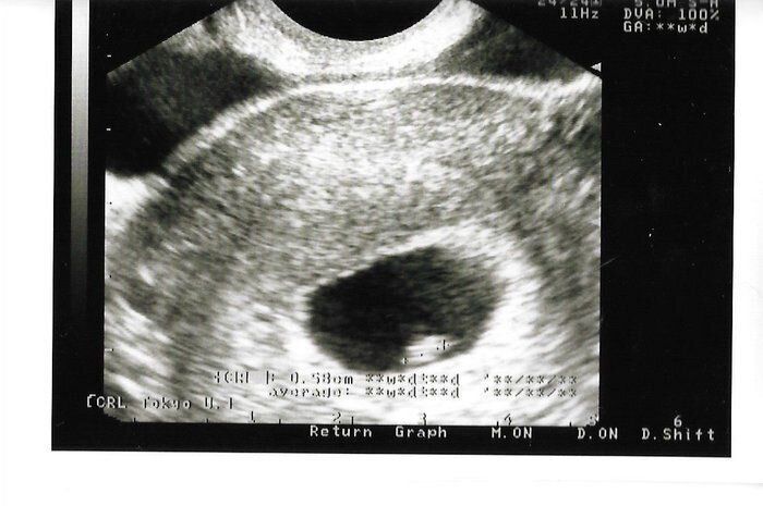 妊娠6週目のエコー写真