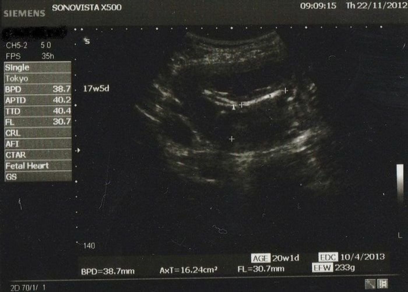 妊娠17週 赤ちゃんのエコー写真 超音波写真まとめ たまひよ 妊娠17週 赤ちゃんのエコー写真 超音波写真まとめ たまひよ