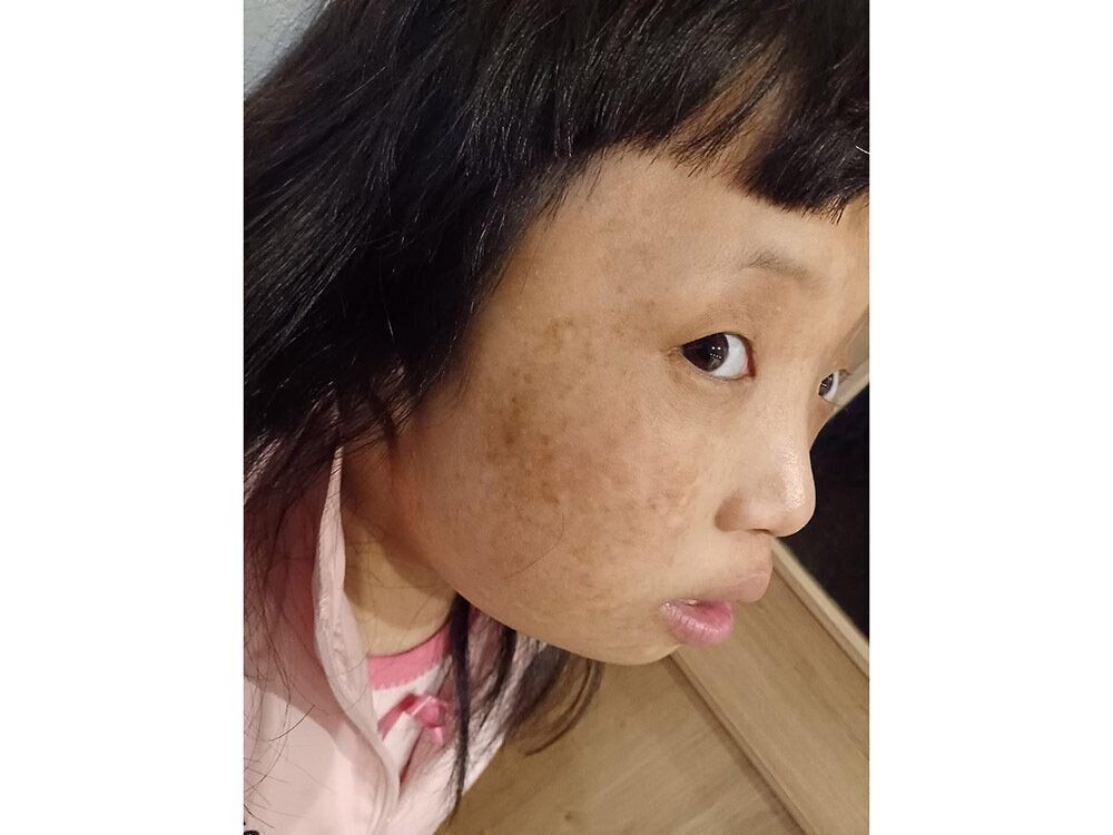 ロスムンド・トムソン症候群による色素沈着した皮膚の様子