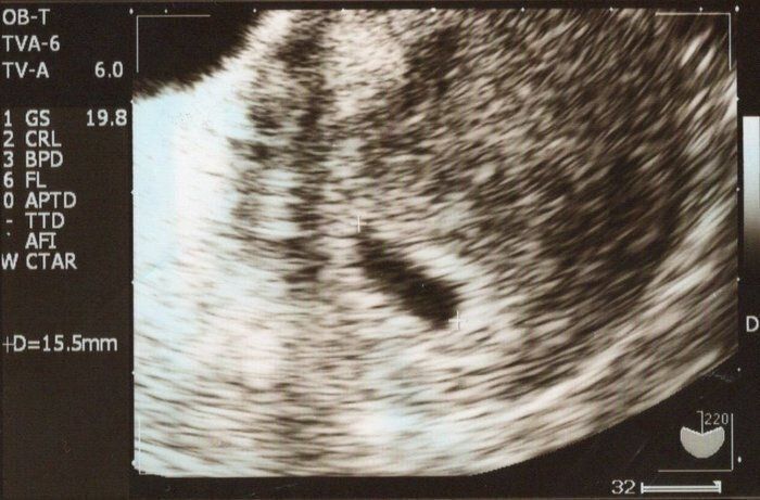 妊娠5週目のエコー写真