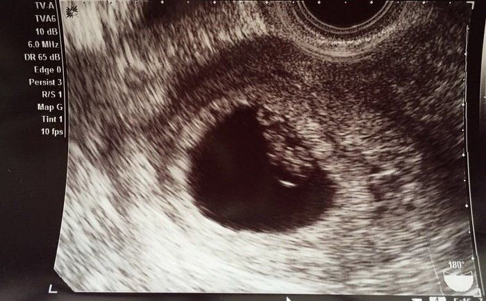 妊娠6週目のエコー写真